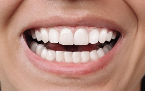 After treatment: Crowded and rotated upper front teeth before treatment, aligned smile after invisible braces. Crowding and rotated upper anteriors corrected with invisible braces — Invisible Braces · 12 month treatment · Vellore